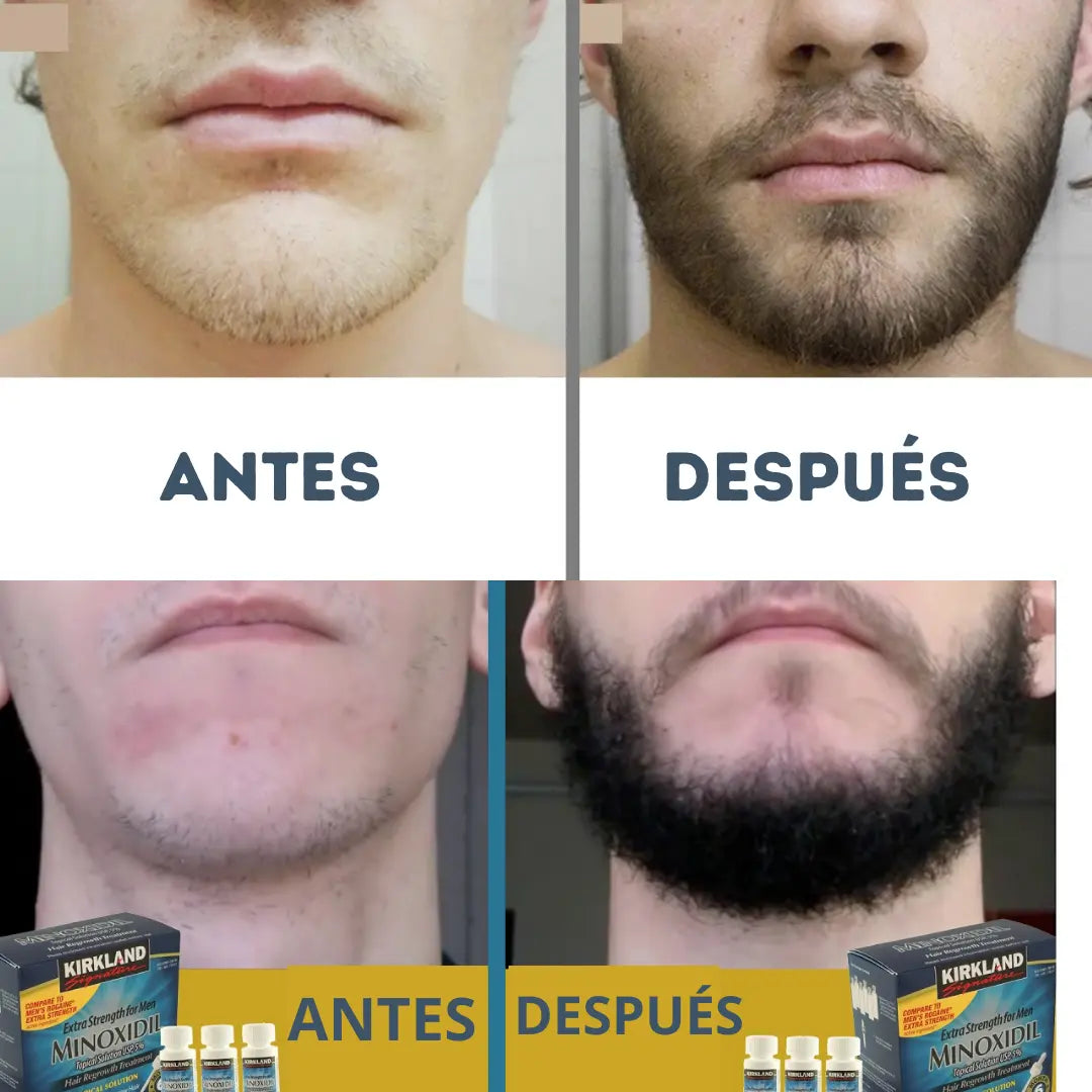 SUPER PROMO - ¡Recupera tu imagen con Minoxidil Kirkland – Llévate 3 y obtén 35% de DESCUENTO HOY!