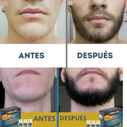 SUPER PROMO - ¡Recupera tu imagen con Minoxidil Kirkland – Llévate 3 y obtén 35% de DESCUENTO HOY!